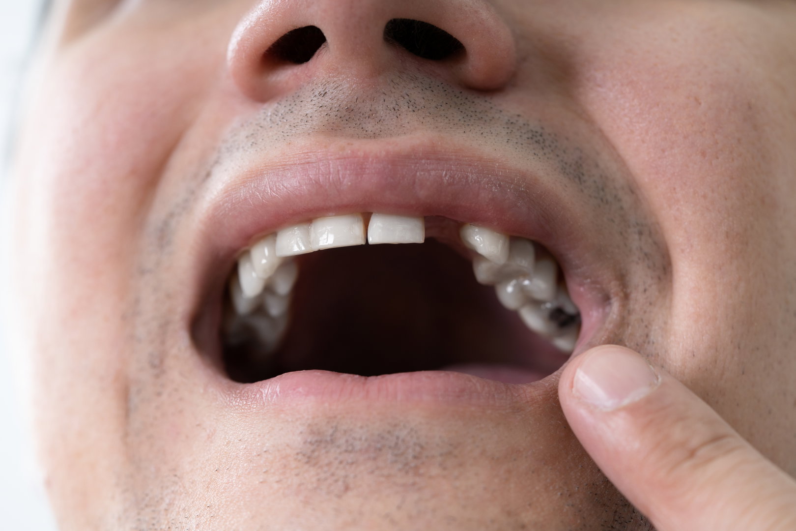 Dental Implant Procedure FAQs